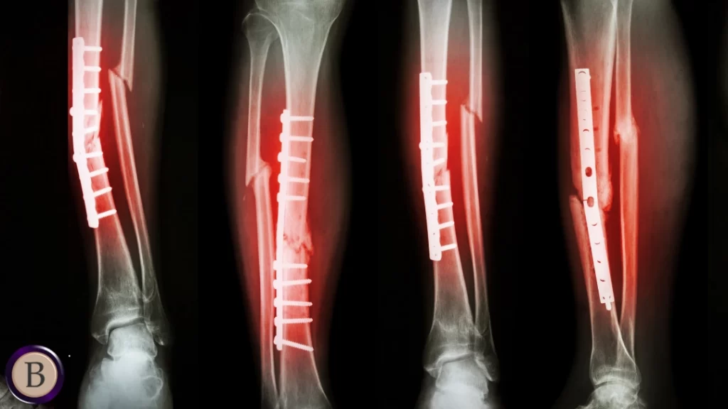 Fracture Treatment Hospitals in Chennai