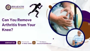 Can You Remove Arthritis from Your Knee?