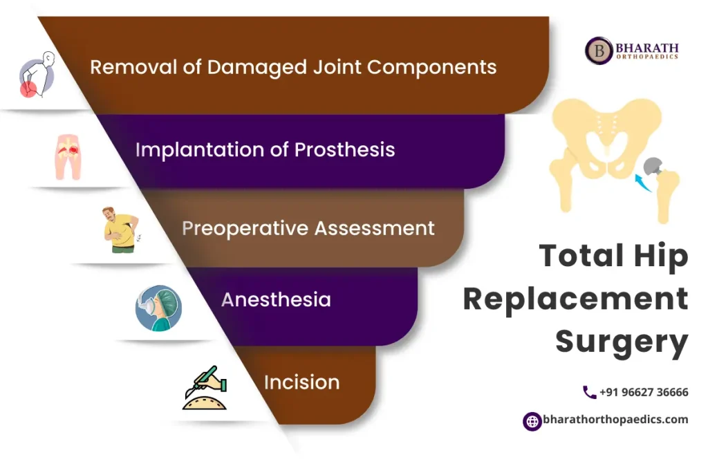 Total Hip Replacement Surgery 100 Best Treatment