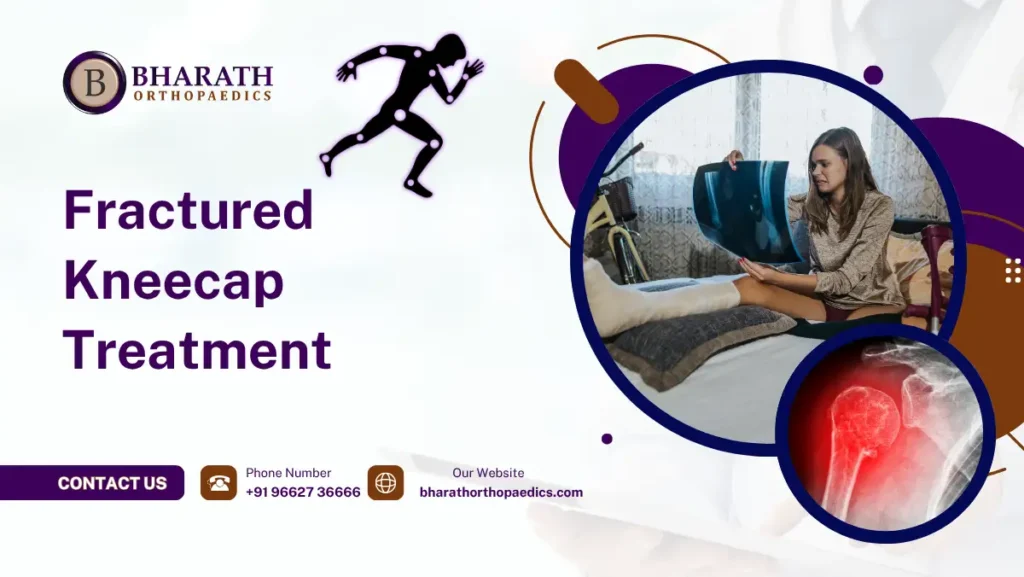 Fractured Kneecap Treatment