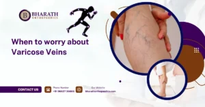 When to worry about Varicose Veins