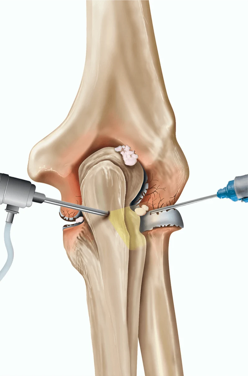 Best Arthroscopic Surgeon in Chennai