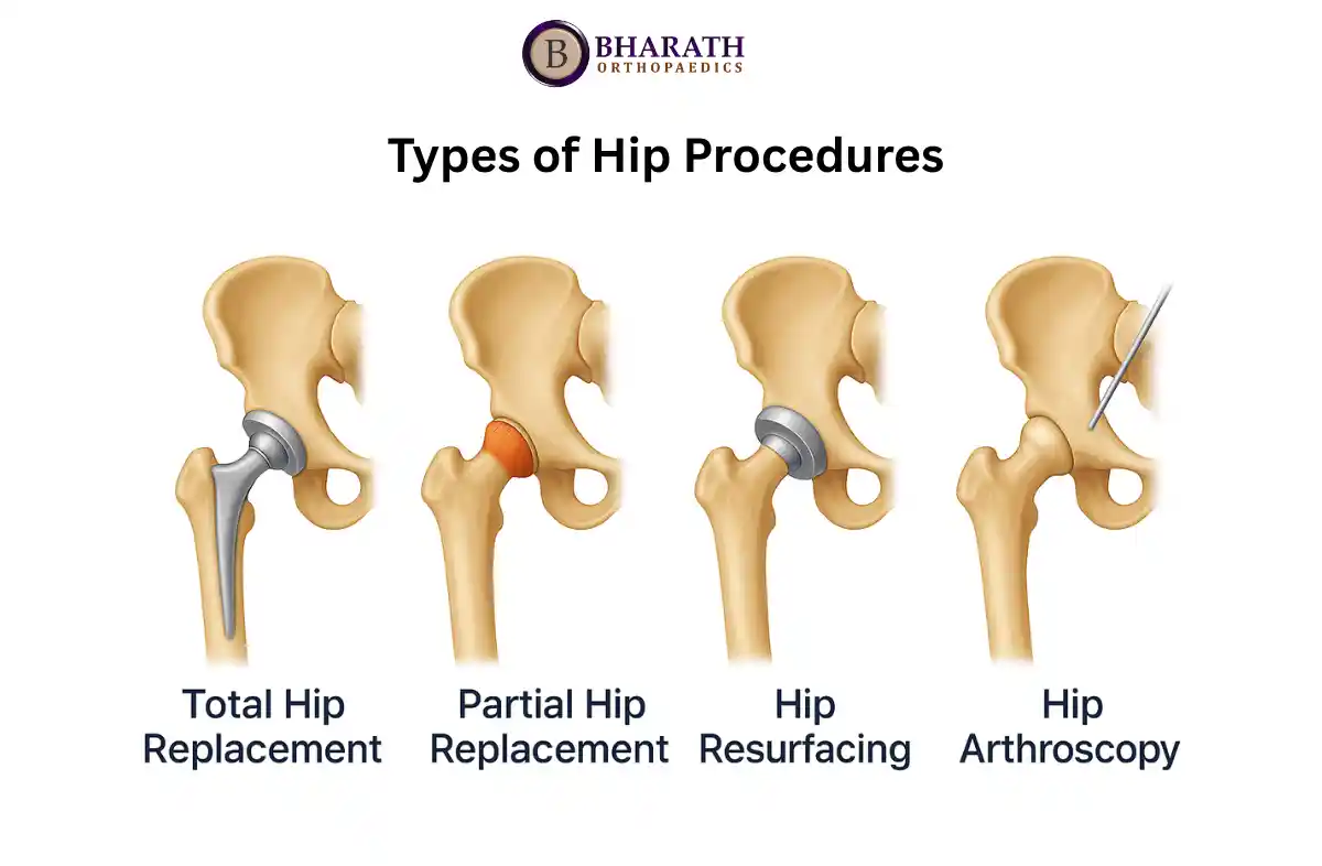 hip procedure