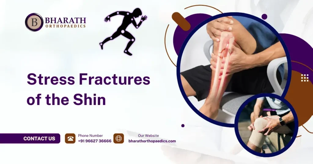 Stress Fractures of the Shin